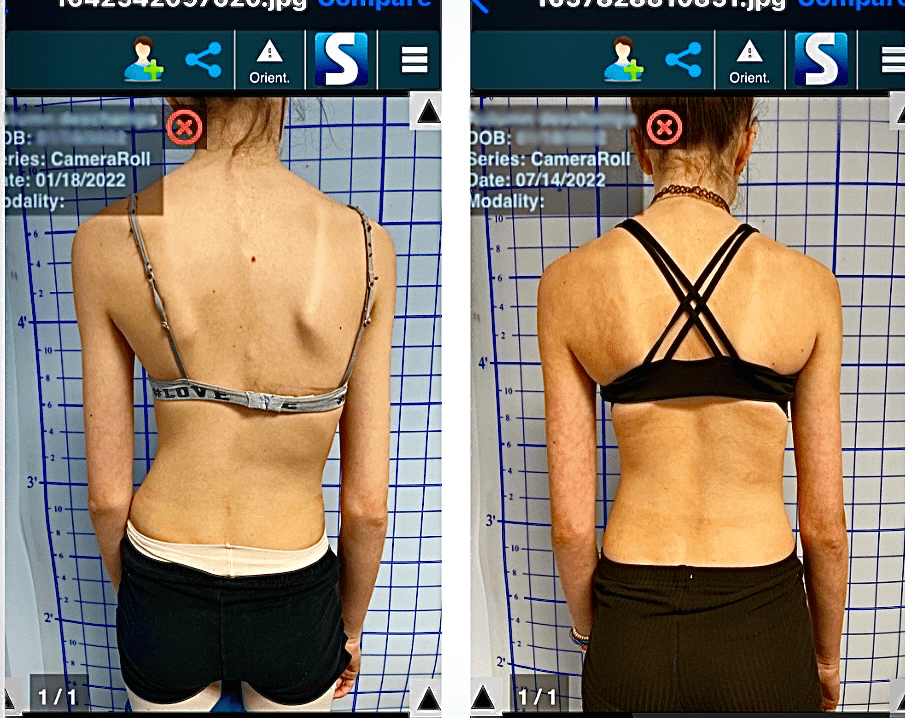back scol before and after