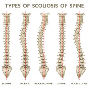 Medical illustration showing common scoliosis curve patterns, including thoracic, lumbar, and double curves.